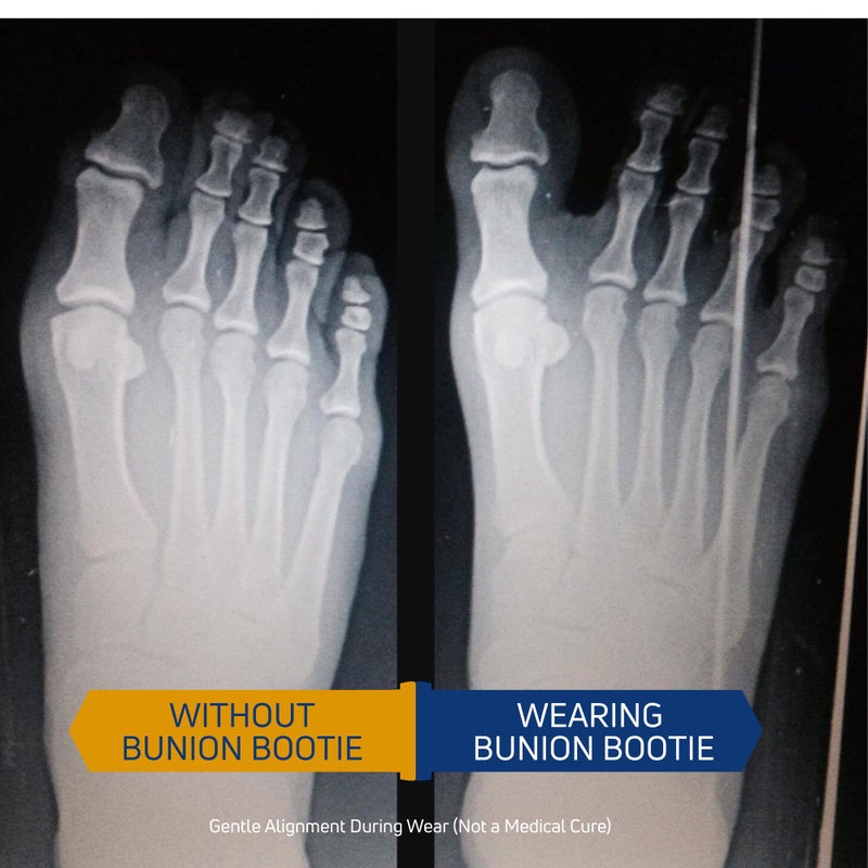 Bunion Bootie مصحح بونيون للنساء لتقويم إصبع القدم الكبير. دعامة بونيون رفيعة للغاية. جورب مناسب للأحذية لتصحيح البونيون. لجميع أنواع الأحذية. تخفيف هالوكس فالغوس لتحسين محاذاة الأصابع. - Image 2